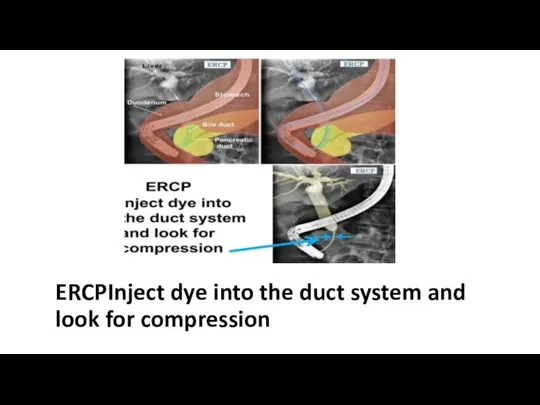 ERCPInject dye into the duct system and look for compression