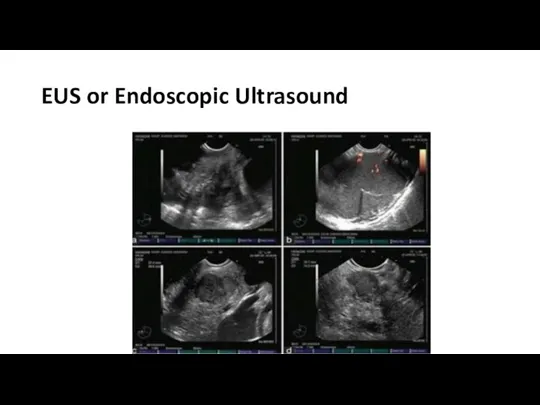 EUS or Endoscopic Ultrasound