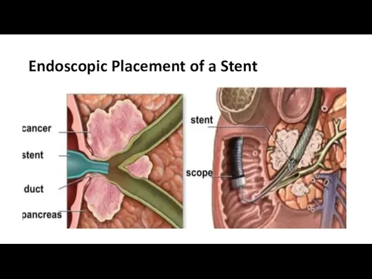 Endoscopic Placement of a Stent