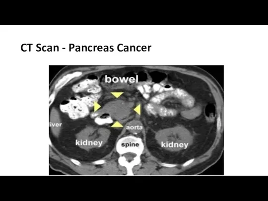 CT Scan - Pancreas Cancer
