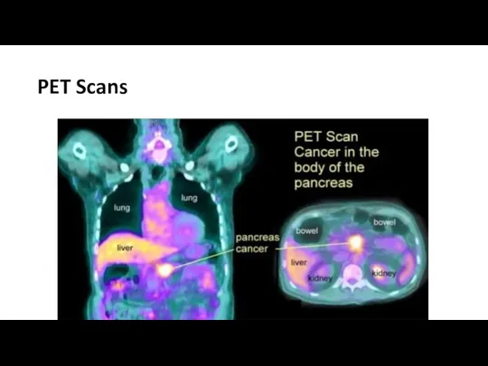 PET Scans