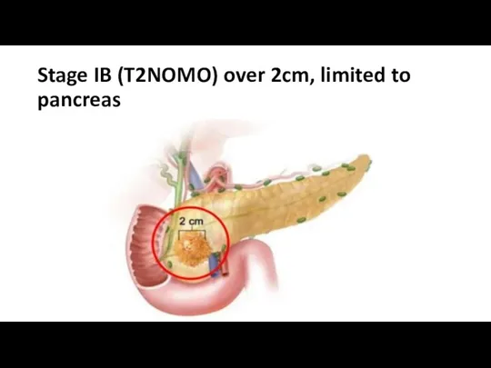 Stage IB (T2NOMO) over 2cm, limited to pancreas
