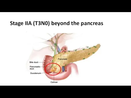 Stage IIA (T3N0) beyond the pancreas