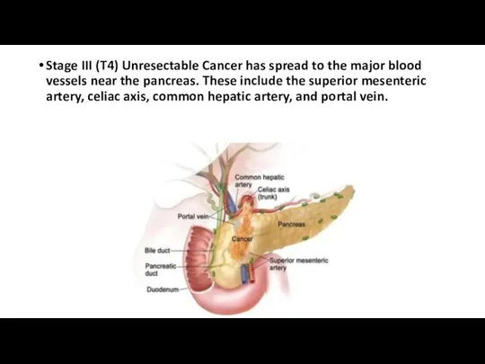 Stage III (T4) Unresectable Cancer has spread to the major blood vessels