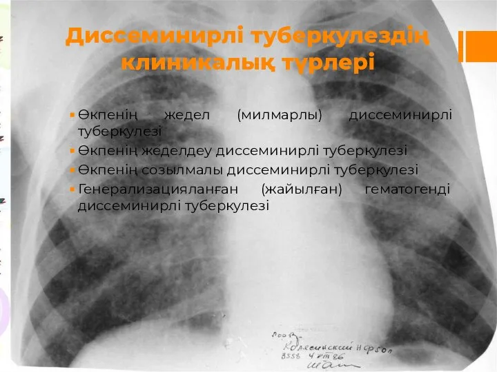 Диссеминирлі туберкулездің клиникалық түрлері Өкпенің жедел (милмарлы) диссеминирлі туберкулезі Өкпенің жеделдеу диссеминирлі