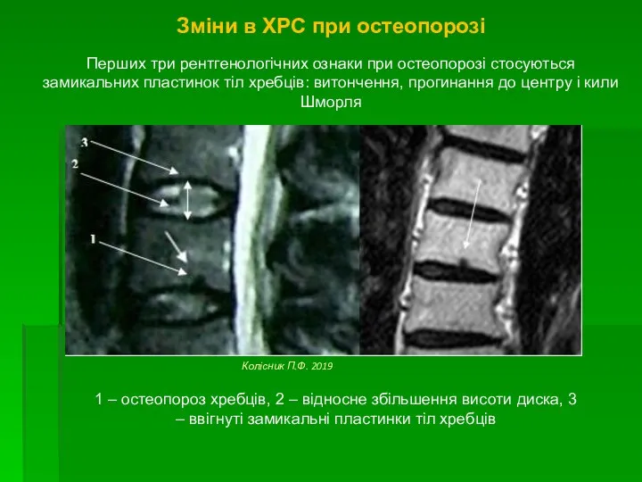 Зміни в ХРС при остеопорозі Перших три рентгенологічних ознаки при остеопорозі стосуються