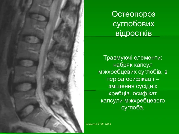 Остеопороз суглобових відростків Травмуючі елементи: набряк капсул міжхребцевих суглобів, в період осифікації