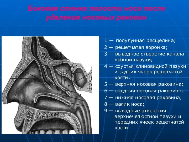 Боковая стенка полости носа после удаления носовых раковин 1 — полулунная расщелина;