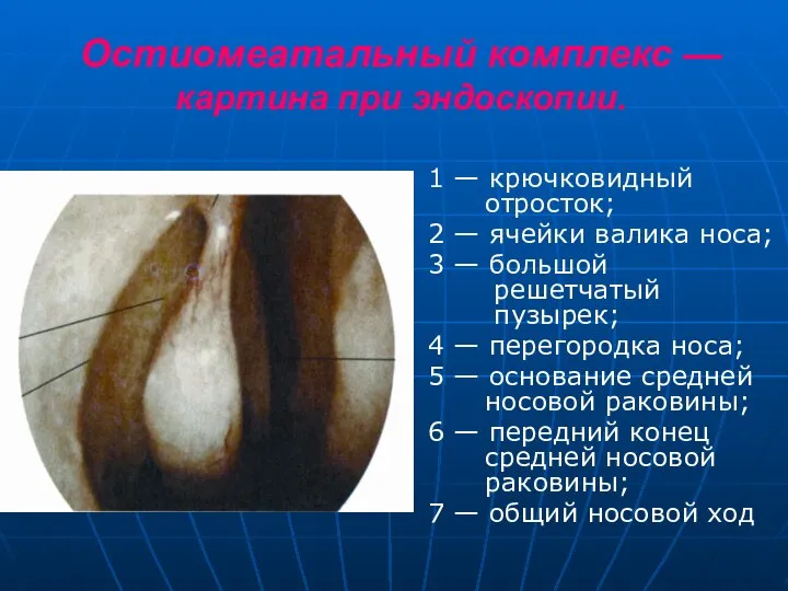 Остиомеатальный комплекс — картина при эндоскопии. 1 — крючковидный отросток; 2 —