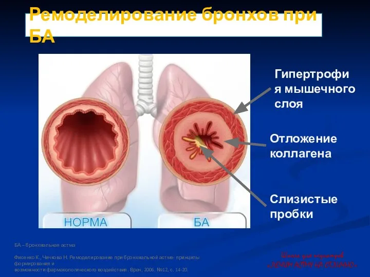 Ремоделирование бронхов при БА Гипертрофия мышечного слоя Отложение коллагена Слизистые пробки БА