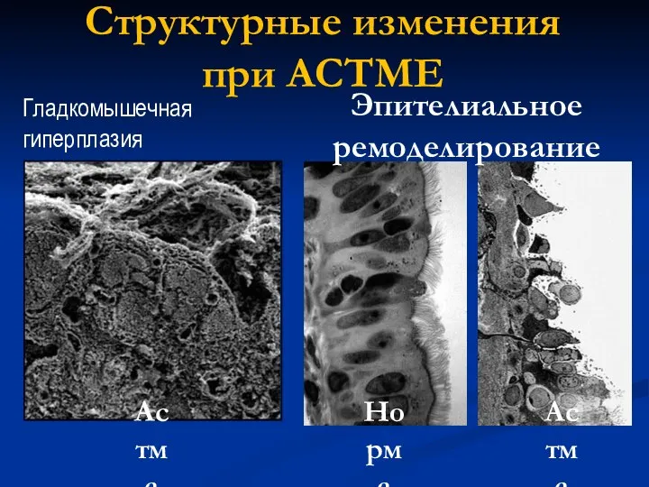 Гладкомышечная гиперплазия Астма Норма Астма Эпителиальное ремоделирование Структурные изменения при АСТМЕ