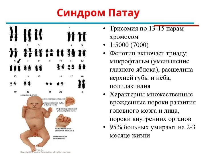 Трисомия по 13-15 парам хромосом 1:5000 (7000) Фенотип включает триаду: микрофтальм (уменьшение