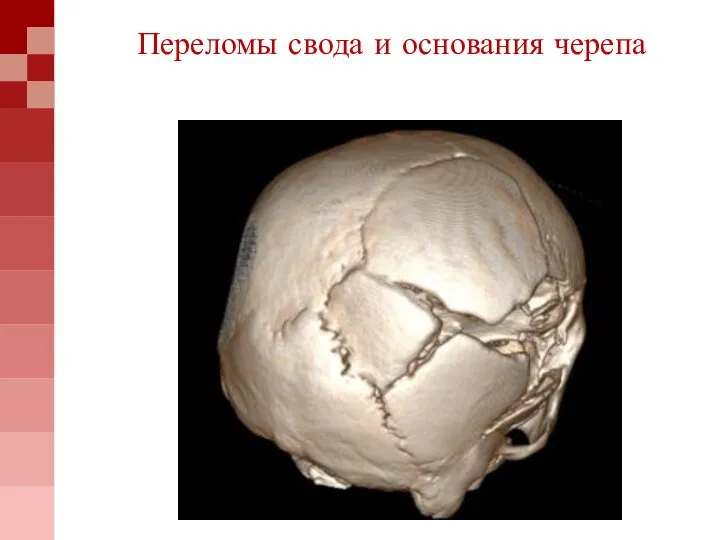 Переломы свода и основания черепа