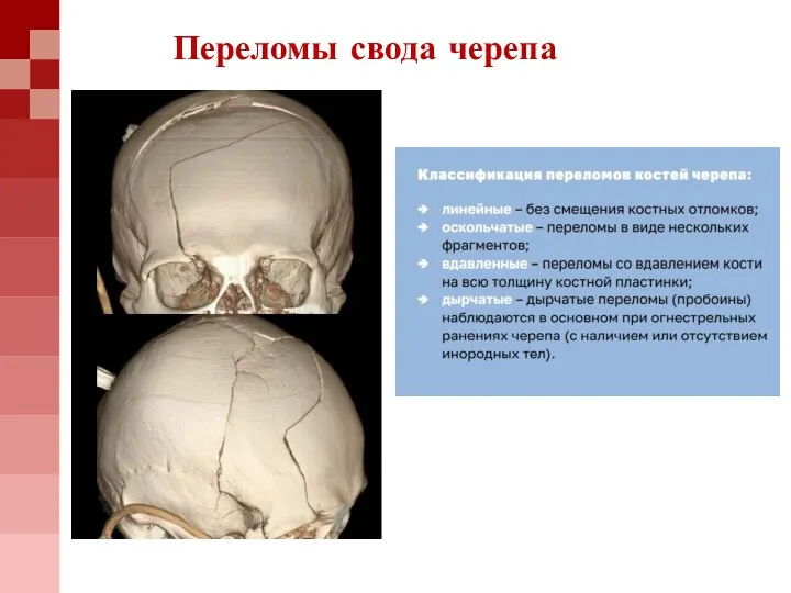 Переломы свода черепа