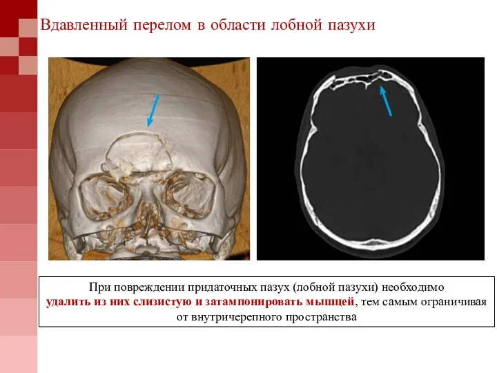 При повреждении придаточных пазух (лобной пазухи) необходимо удалить из них слизистую и