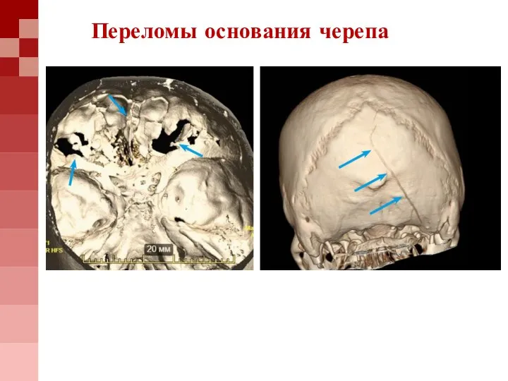 Переломы основания черепа