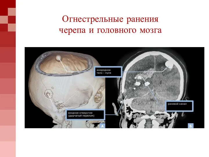 Огнестрельные ранения черепа и головного мозга