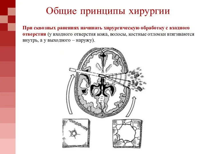 При сквозных ранениях начинать хирургическую обработку с входного отверстия (у входного отверстия