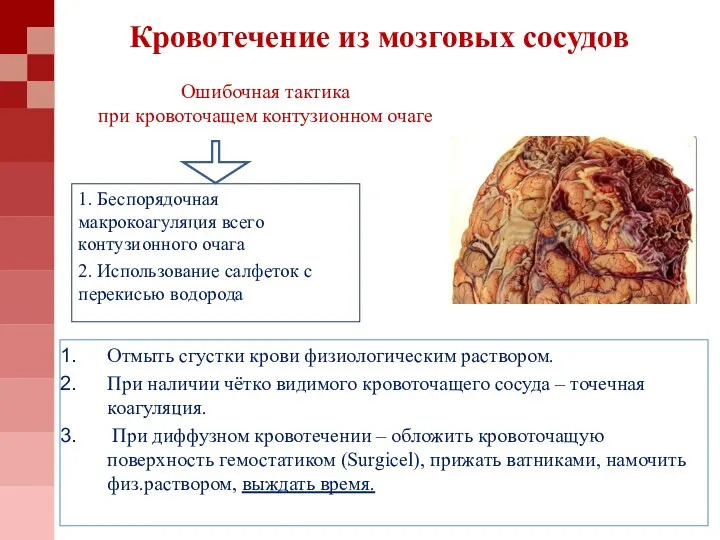 Ошибочная тактика при кровоточащем контузионном очаге 1. Беспорядочная макрокоагуляция всего контузионного очага