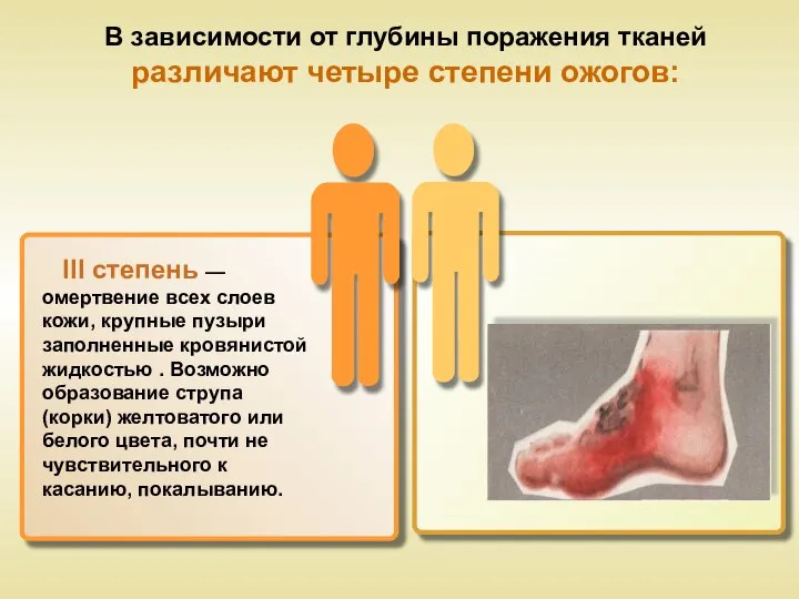 В зависимости от глубины поражения тканей различают четыре степени ожогов: