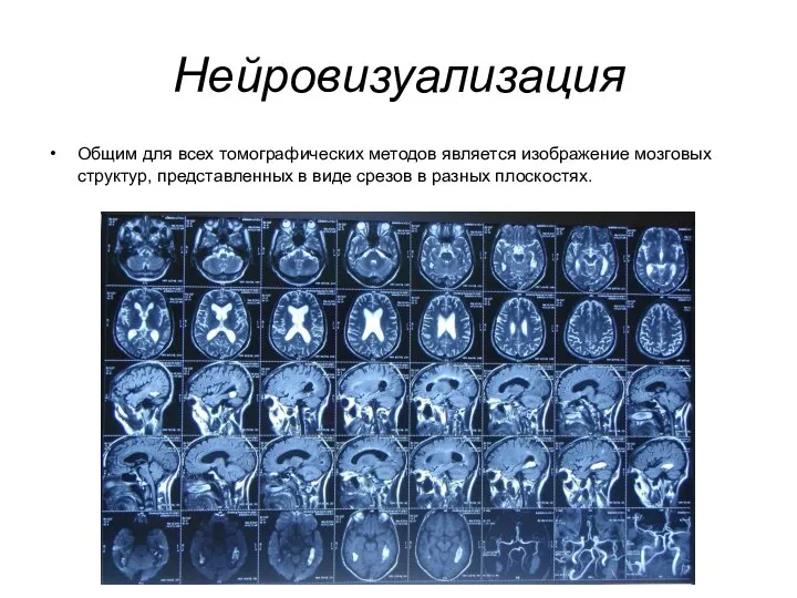 Нейровизуализация Общим для всех томографических методов является изображение мозговых структур, представленных в
