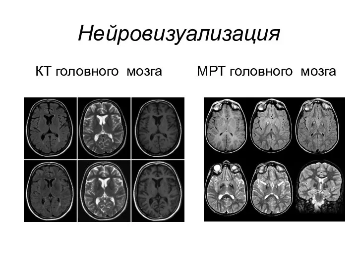 Нейровизуализация КТ головного мозга МРТ головного мозга