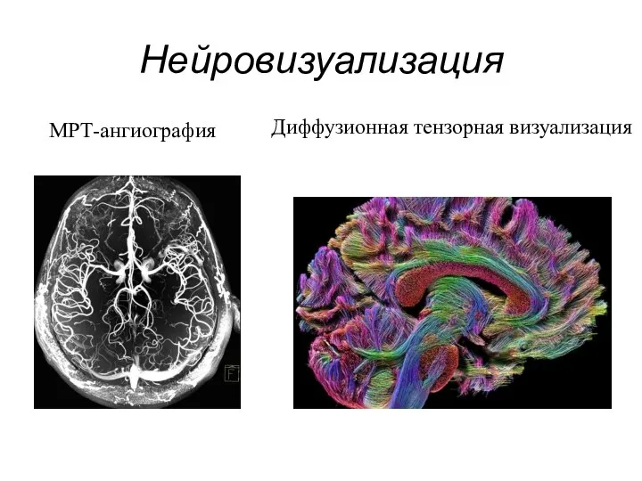 Нейровизуализация МРТ-ангиография Диффузионная тензорная визуализация
