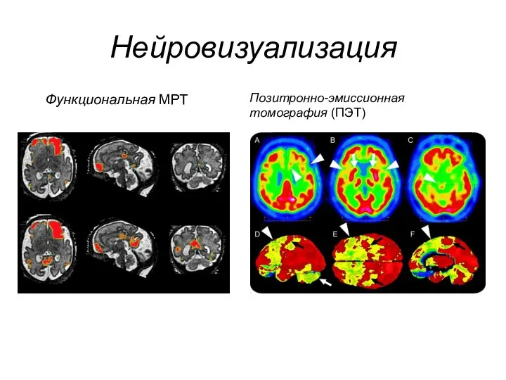 Нейровизуализация Функциональная МРТ Позитронно-эмиссионная томография (ПЭТ)