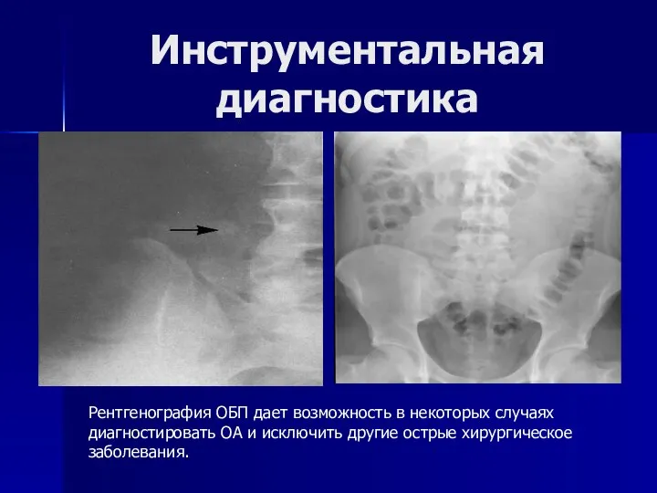 Инструментальная диагностика Рентгенография ОБП дает возможность в некоторых случаях диагностировать ОА и