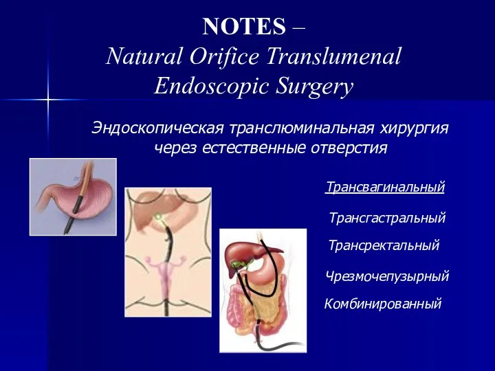 NOTES – Natural Orifice Translumenal Endoscopic Surgery Эндоскопическая транслюминальная хирургия через естественные