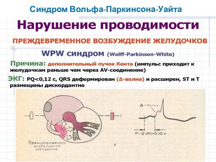 Синдром Вольфа-Паркинсона-Уайта