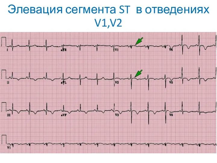 Элевация сегмента ST в отведениях V1,V2