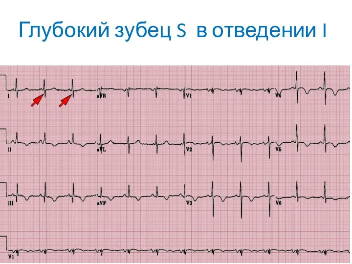 Глубокий зубец S в отведении I