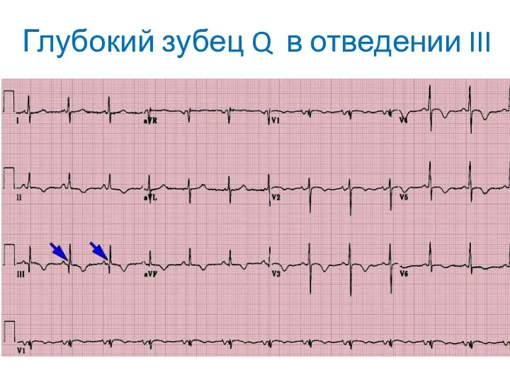 Глубокий зубец Q в отведении III