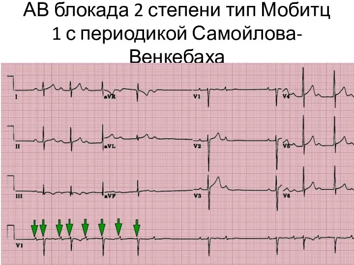 АВ блокада 2 степени тип Мобитц 1 с периодикой Самойлова-Венкебаха