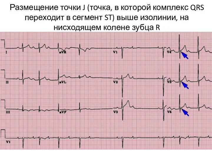 Размещение точки J (точка, в которой комплекс QRS переходит в сегмент ST)