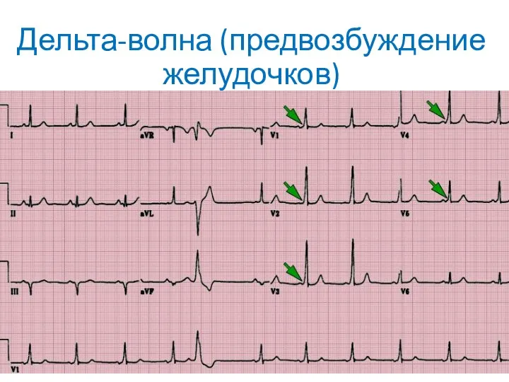 Дельта-волна (предвозбуждение желудочков)