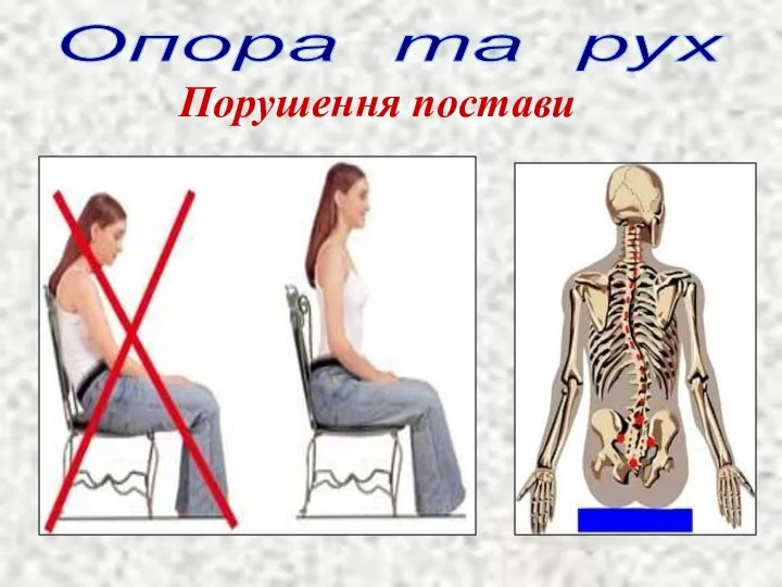 Опора та рух Порушення постави