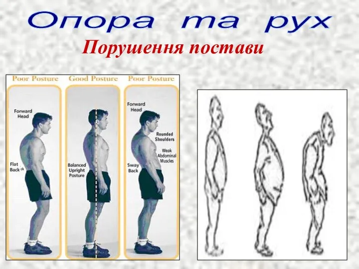 Опора та рух Порушення постави