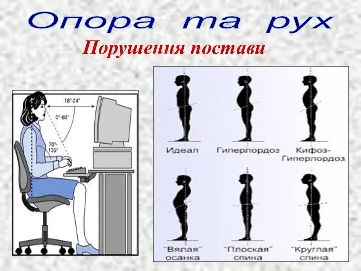 Опора та рух Порушення постави