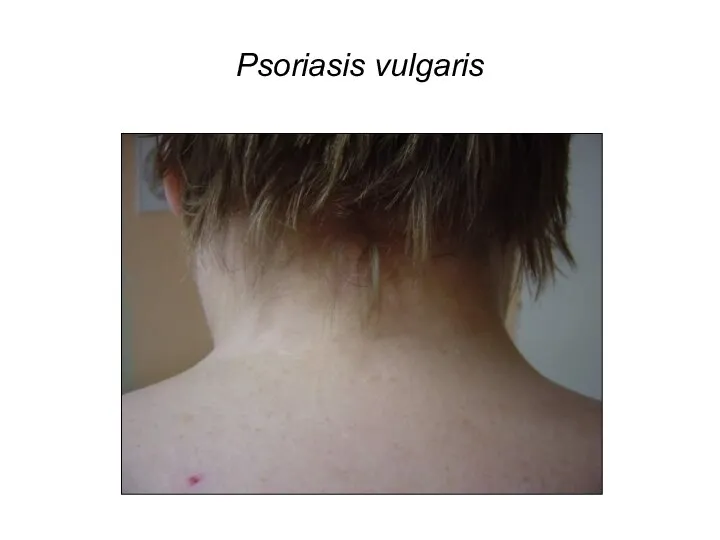 Psoriasis vulgaris