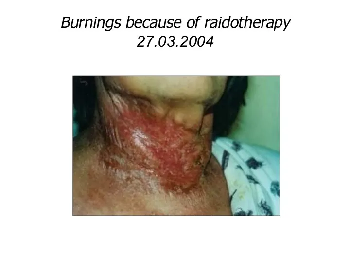 Burnings because of raidotherapy 27.03.2004