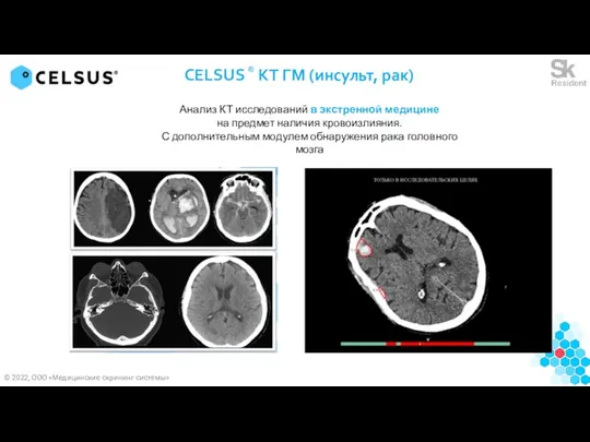 CELSUS ® КТ ГМ (инсульт, рак) Анализ КТ исследований в экстренной медицине