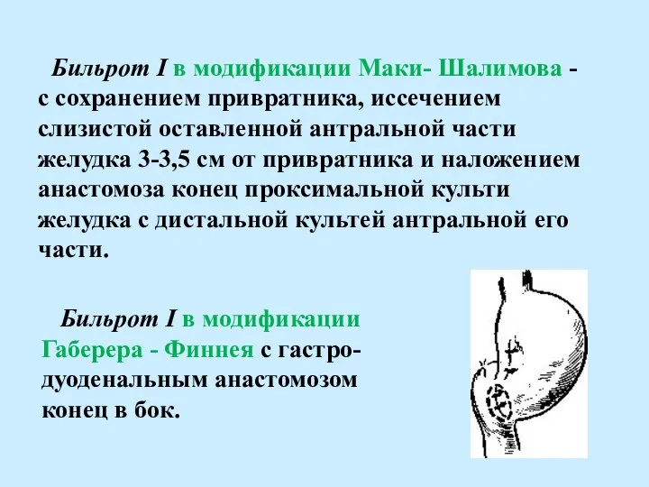 Бильрот I в модификации Маки- Шалимова - с сохранением привратника, иссечением слизистой
