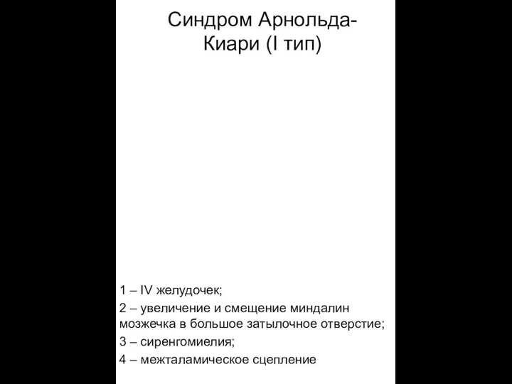 Синдром Арнольда-Киари (I тип) 1 – IV желудочек; 2 – увеличение и