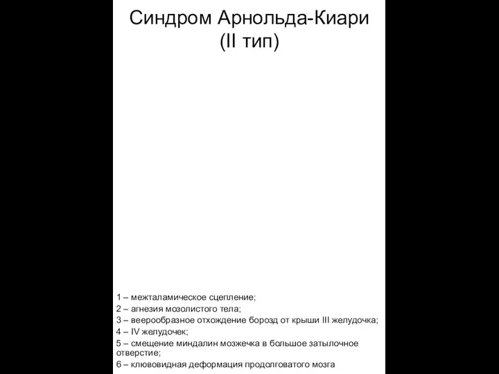 Синдром Арнольда-Киари (II тип) 1 – межталамическое сцепление; 2 – агнезия мозолистого