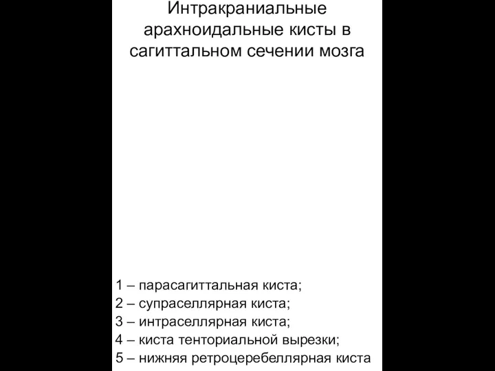 Интракраниальные арахноидальные кисты в сагиттальном сечении мозга 1 – парасагиттальная киста; 2