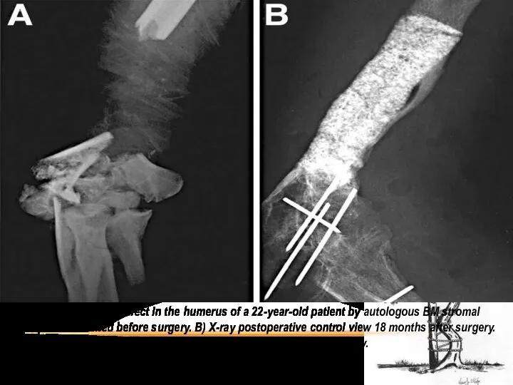 Repair of a large bone defect in the humerus of a 22-year-old