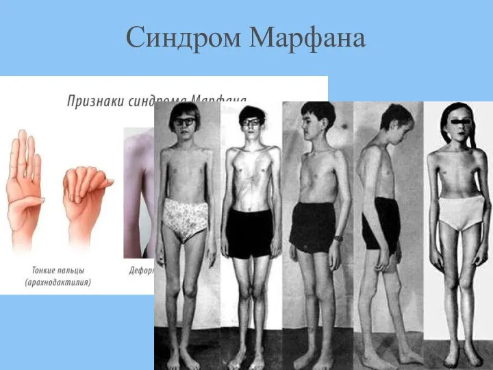 Синдром Марфана