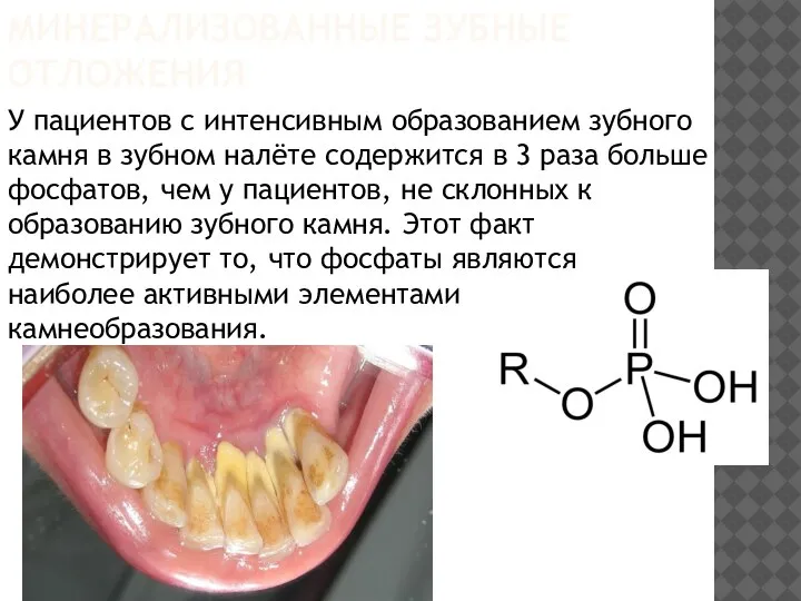 МИНЕРАЛИЗОВАННЫЕ ЗУБНЫЕ ОТЛОЖЕНИЯ У пациентов с интенсивным образованием зубного камня в зубном
